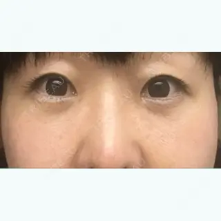 14日目の経過画像（1枚目）