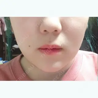 11日目の経過画像（1枚目）
