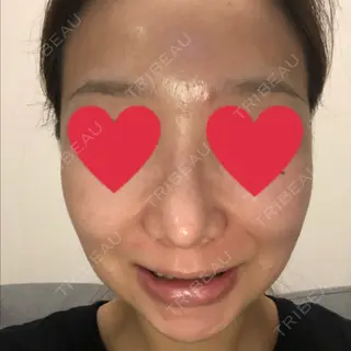 8日目の経過画像（2枚目）
