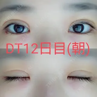 12日目の経過画像（1枚目）