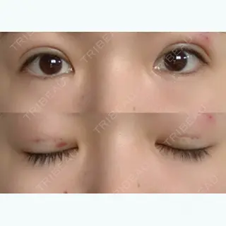 5日目の経過画像（1枚目）