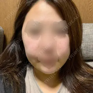 5日目の経過画像（1枚目）