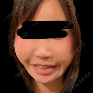 26日目の経過画像（1枚目）