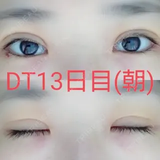 13日目の経過画像（1枚目）