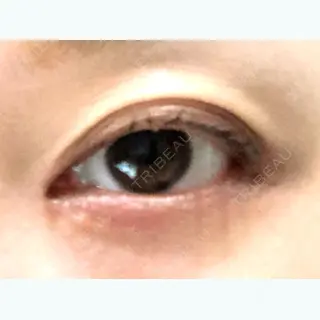 20日目の経過画像（2枚目）