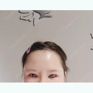 8日目の経過画像（2枚目）