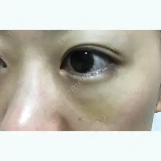 21日目の経過画像（2枚目）