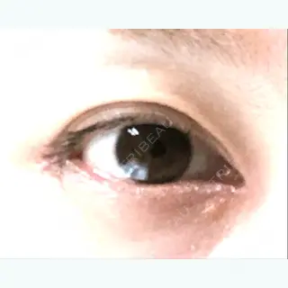 22日目の経過画像（1枚目）