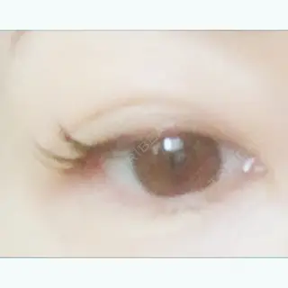 4日目の経過画像（1枚目）