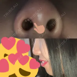 1日目の経過画像（2枚目）