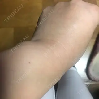 2日目の経過画像（2枚目）