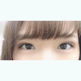 44日目の経過画像（2枚目）