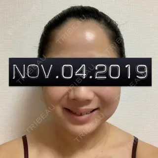 2日目の経過画像（2枚目）