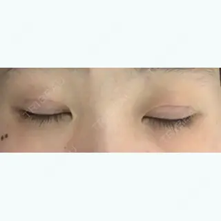 5日目の経過画像（2枚目）