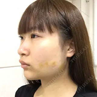 1日目の経過画像（2枚目）
