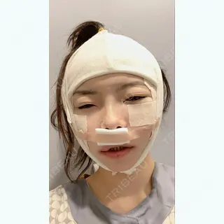 0日目の経過画像（3枚目）