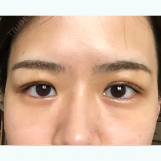 3日目の経過画像（1枚目）