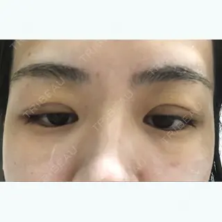 4日目の経過画像（2枚目）