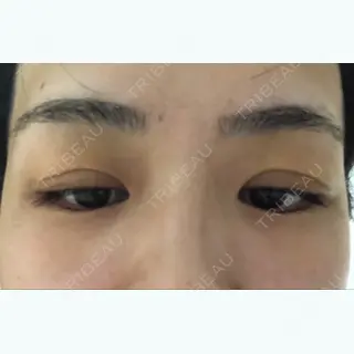 6日目の経過画像（2枚目）