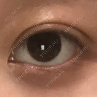 5日目の経過画像（3枚目）