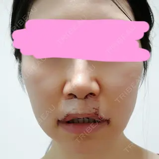 0日目の経過画像（1枚目）