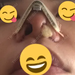 2日目の経過画像（2枚目）