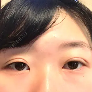 1日目の経過画像（1枚目）