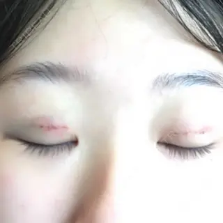 1日目の経過画像（2枚目）