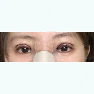 0日目の経過画像（1枚目）