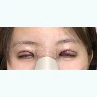 0日目の経過画像（2枚目）