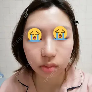 0日目の経過画像（1枚目）