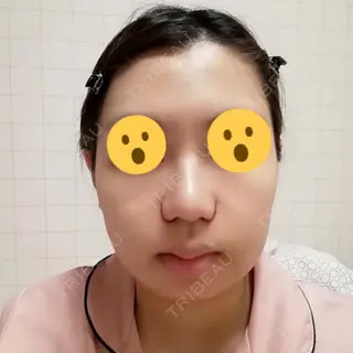 3日目の経過画像（1枚目）