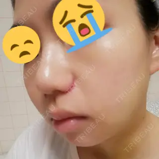 5日目の経過画像（3枚目）