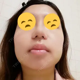 7日目の経過画像（2枚目）