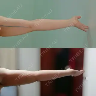 3日目の経過画像（2枚目）
