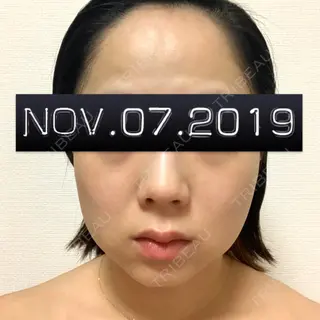 5日目の経過画像（1枚目）