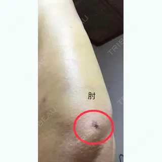 7日目の経過画像（3枚目）
