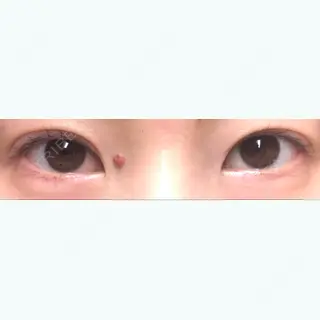 99日目の経過画像（1枚目）