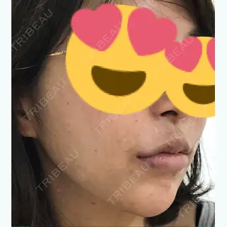 2日目の経過画像（2枚目）