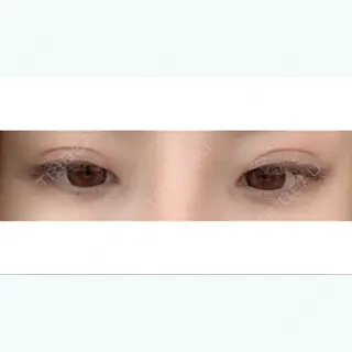 6日目の経過画像（2枚目）