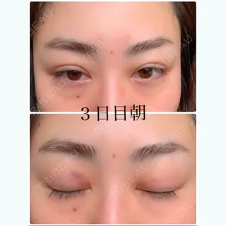 2日目の経過画像（1枚目）