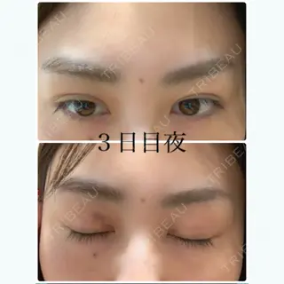 2日目の経過画像（1枚目）