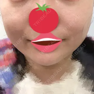 2日目の経過画像（2枚目）