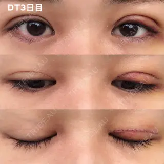 3日目の経過画像（1枚目）
