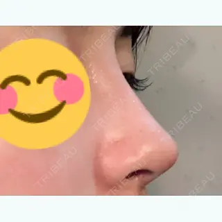 12日目の経過画像（1枚目）