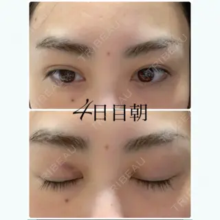 3日目の経過画像（1枚目）