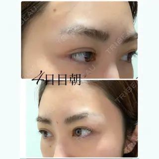 3日目の経過画像（2枚目）