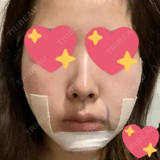0日目の経過画像（1枚目）