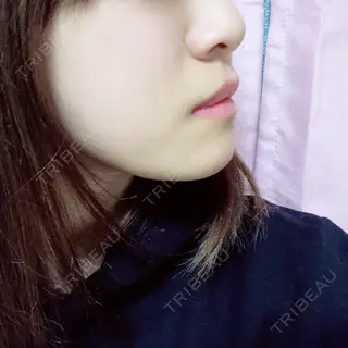29日目の経過画像（2枚目）
