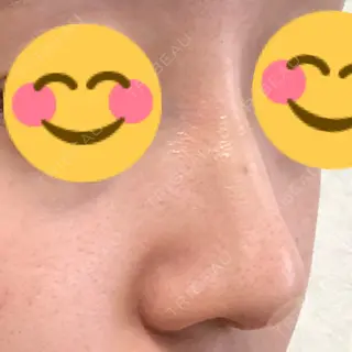 2日目の経過画像（1枚目）